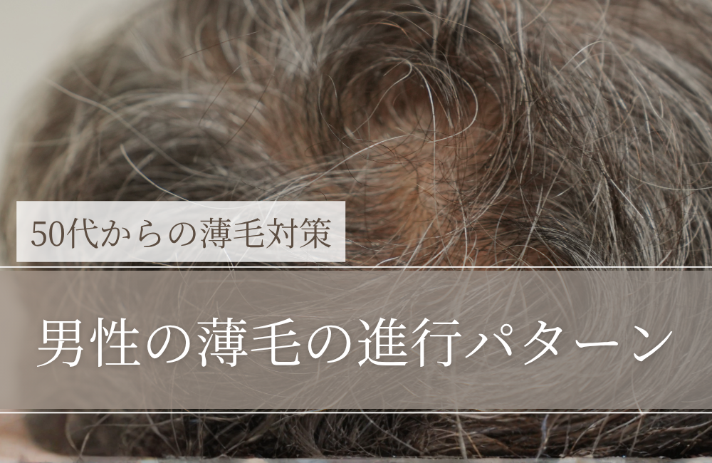男性の薄毛の進行パターン｜50代から「どこが先に薄くなるか」を知る