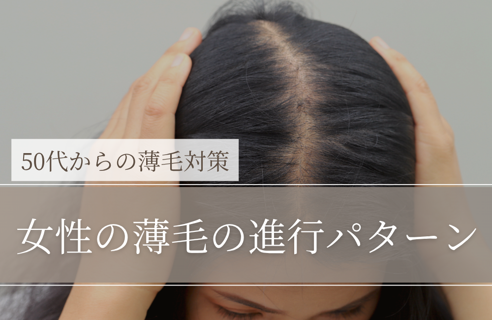 女性の薄毛の進行パターン｜50代女性が「気づきやすい変化」と対策の考え方